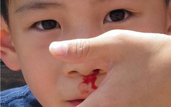 Mẹo làm ngừng chảy máu cam tại nhà hiệu quả