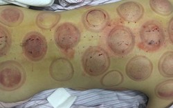 Nữ diễn viên tử vong vì điều trị ung thư bằng giác hơi