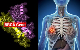 Nguy cơ ung thư vú do gene BRCA và cách hạn chế rủi ro
