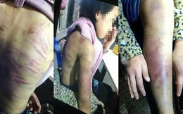 Người thân lo lắng khi bé gái 12 tuổi bị người tình của mẹ hiếp dâm sút tận 5kg 