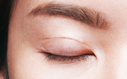 Cô gái 20 tuổi bị mù sau khi mổ cắt mí mắt ở spa 