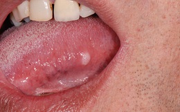 Cách phân biệt giữa nhiệt miệng và ung thư lưỡi