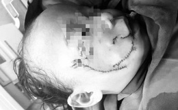 Bé 3 tuổi bị chó nhà cắn hàng chục vết thương trên mặt