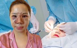 Tại sao gương mặt thường phù lên sau phẫu thuật thẩm mỹ, có nguy hiểm không?