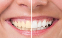Làm trắng răng có an toàn và đáng “đồng tiền bát gạo”?