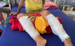 Quảng Bình: Điều tra việc bé trai bị cha đốt bỏng 2 chân