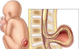 Thử nghiệm liệu pháp tế bào gốc trị tật nứt đốt sống