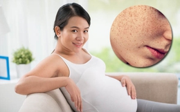 Bác sĩ da liễu chia sẻ kiến thức quan trọng về nám da khi mang thai