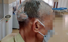 Bệnh nhân nhập viện với tấm Titatium hở trên sọ não