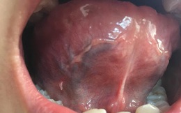 Mặt dưới lưỡi có sợi thịt là bệnh gì?