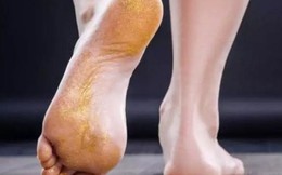 Bàn chân xuất hiện 3 dấu hiệu này chứng tỏ gan đang "cầu cứu"