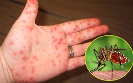 Trẻ bị sốt xuất huyết làm gì cho nhanh khỏi?