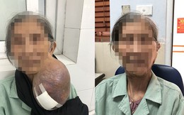 Cụ bà 40 năm đeo khối u khổng lồ trên cổ