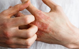 2 bộ phận trên cơ thể bị ngứa là dấu hiệu mắc bệnh tiểu đường
