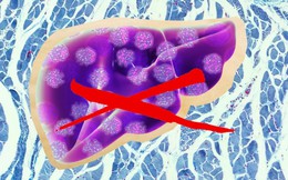 Phát hiện loại virus mới gây bệnh viêm gan ở một bệnh nhân nữ