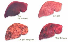 Chuyên gia ung bướu chỉ ra 8 yếu tố nguy cơ dẫn đến ung thư gan