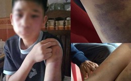 Bố đẻ và mẹ kế đánh cháu bé bầm tím khắp người