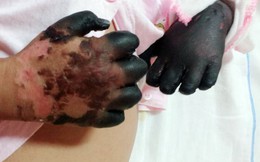 Mắc bệnh Than, bé 3 tuổi phải tháo khớp tay chân