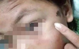 Hội LHPN Hà Tĩnh yêu cầu điều tra, làm rõ vụ bé gái bị công an viên đánh bầm tím