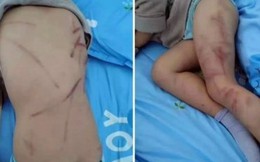 Bé trai 4 tuổi bị mẹ đánh trọng thương do ị đùn 