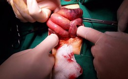 Xoắn ruột khiến bé gái sơ sinh phải cắt bỏ buồng trứng