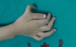 Phẫu thuật dị tật cho bé gái với bàn tay hai ngón cái