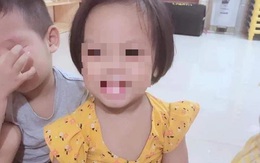 Sức khỏe bé 3 tuổi nghi bị bạo hành với 9 chiếc đinh ghim ở đầu hiện như thế nào? 