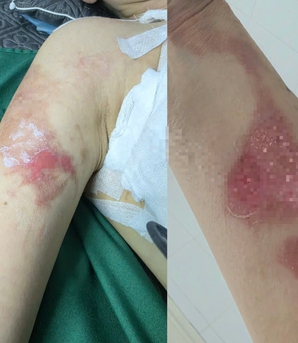 Người phụ nữ tố bị bỏng khi sử dụng dịch vụ tại spa ở Hà Nội