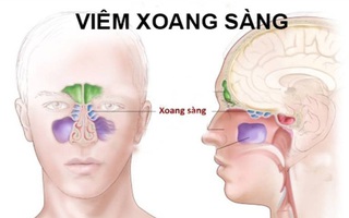 Viêm xoang sàng: loại viêm xoang thường gặp nhất, có thể dẫn đến biến chứng nguy hiểm