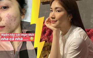 Học Hòa Minzy cách "đuổi" sạch mụn nhờ skincare hơn 1 tiếng mỗi ngày