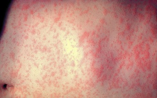 Phân biệt bệnh sởi và bệnh sốt phát ban