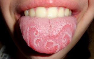 Nếu miệng có 3 điểm bất thường chứng tỏ dạ dày đã tổn thương, có thể dẫn đến ung thư