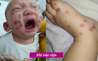 Bé 6 tháng tuổi mắc bệnh cực hiếm, Việt Nam chưa từng ghi nhận