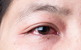 Gai người trước những hình ảnh triệu chứng của bệnh đau mắt đỏ