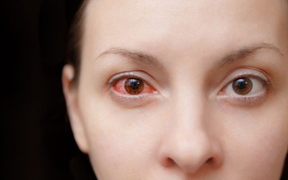 12 câu hỏi thường gặp về bệnh đau mắt đỏ 