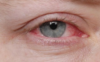 Các bước vệ sinh mắt đúng cách khi bị đau mắt đỏ để nhanh khỏi bệnh và phòng ngừa biến chứng