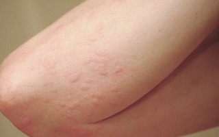 Sẩn ngứa mùa hè: Bệnh ngoài da thường gặp cần cảnh giác