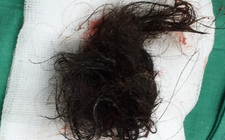 Hãi hùng khối u quái buồng trứng chứa đầy tóc của cô gái 21 tuổi
