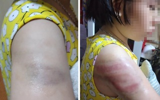Nam Định: Xác minh thông tin học sinh lớp 4 bị cô giáo đánh tím người
