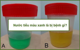 Đi ra nước tiểu màu xanh là bệnh gì?