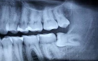 Ảnh hưởng của nhổ răng lên hệ thần kinh 