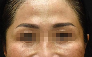 Độc tố botulinum có thể giúp trẻ hóa làn da, làm thon gọn khuôn mặt