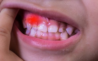 Những điều cần biết về tình trạng viêm nướu răng ở trẻ em
