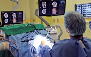 Ứng dụng kỹ thuật công nghệ cao định vị 3 chiều Navigation trong phẫu thuật xuất huyết não
