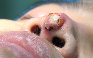 Sau phẫu thuật 4 năm, mũi người phụ nữ bị thủng, lộ cả sụn sillicon ra ngoài