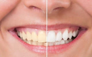 Làm trắng răng có an toàn và đáng “đồng tiền bát gạo”?