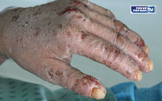 Nhiễm trùng nặng do chích vỡ các mụn nước ở lòng bàn tay, chân