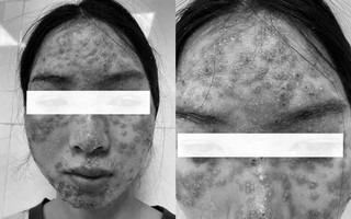 "Detox" da tại spa, cô gái bị bội nhiễm da Eczema herpeticum