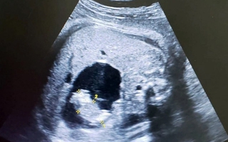 Siêu âm song thai nhưng đẻ 1 em bé có 2 dây rốn, bác sĩ xét nghiệm thì phát hiện điều hiếm gặp