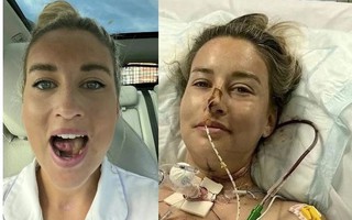 Đi khám nhiệt miệng, cô gái 27 tuổi phải cắt bỏ một nửa lưỡi vì ung thư